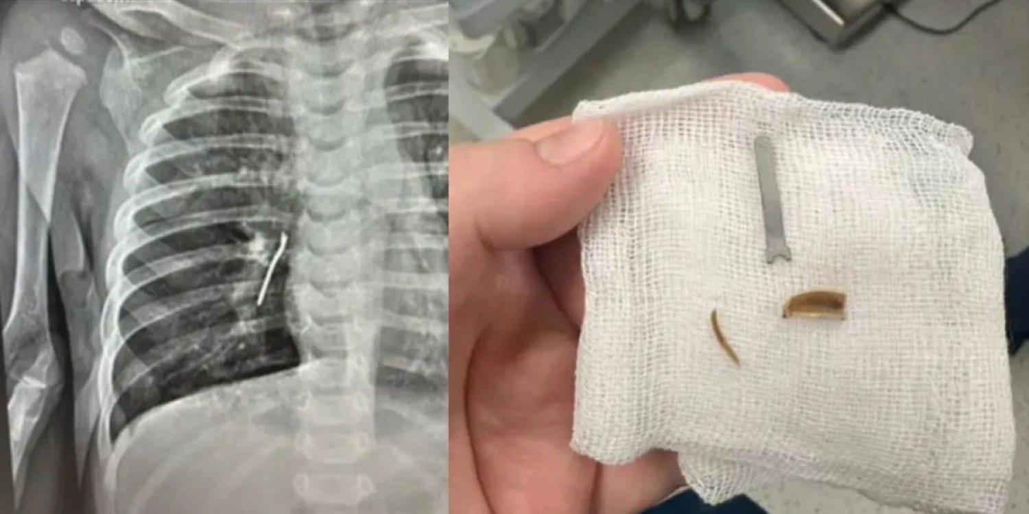 Ақтауда 11 айлық баланың өкпесінен темір бөлшегі мен тұқым қабығы шықты 