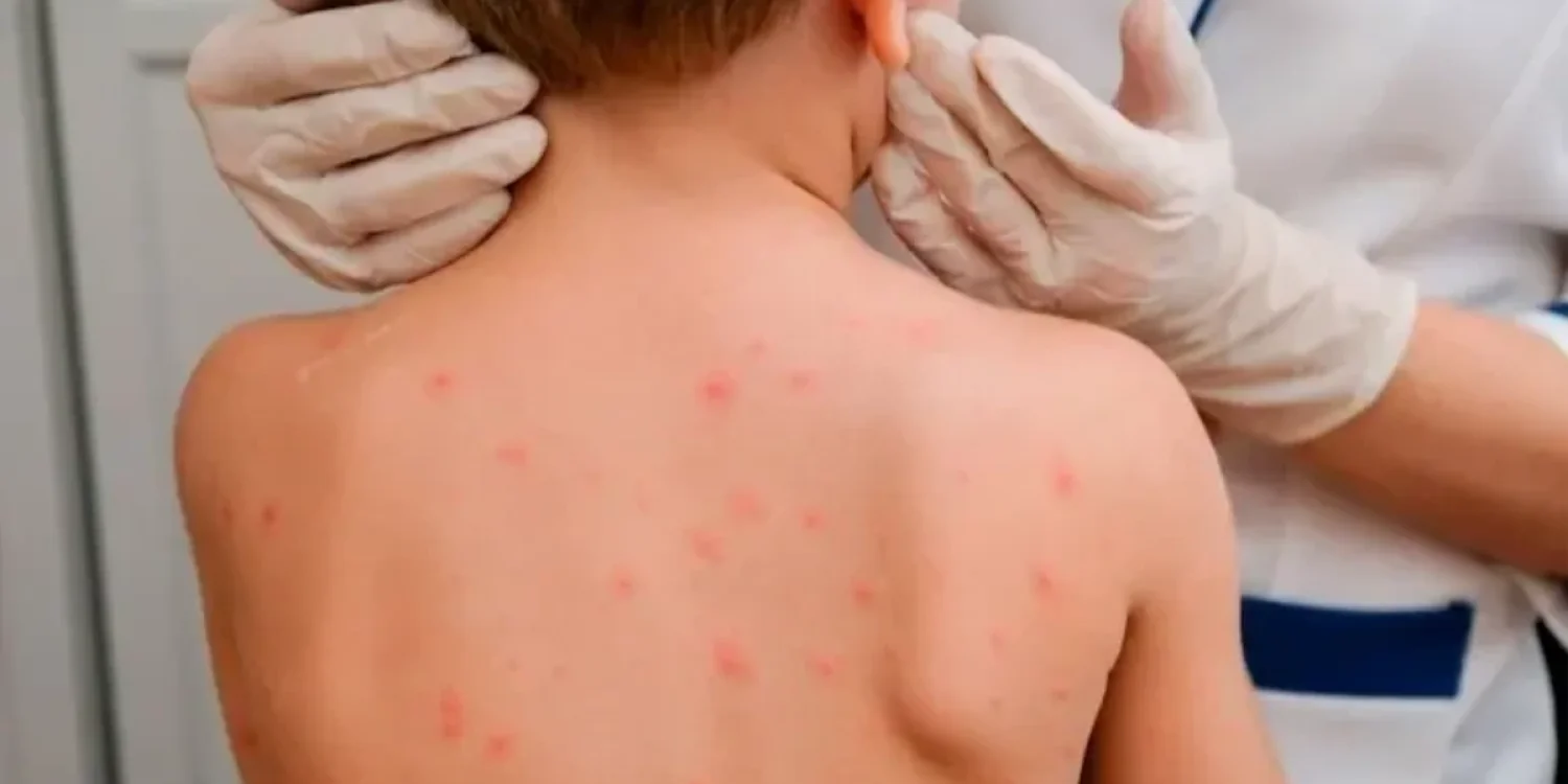 «Ауру өршіп тұр»: Екпе алмаған балалар сабақтан уақытша шеттетіледі