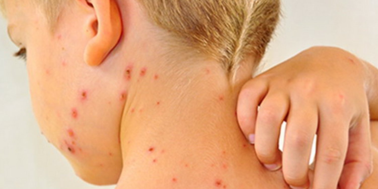 В Алматы зафиксирован рост заболеваемости корью