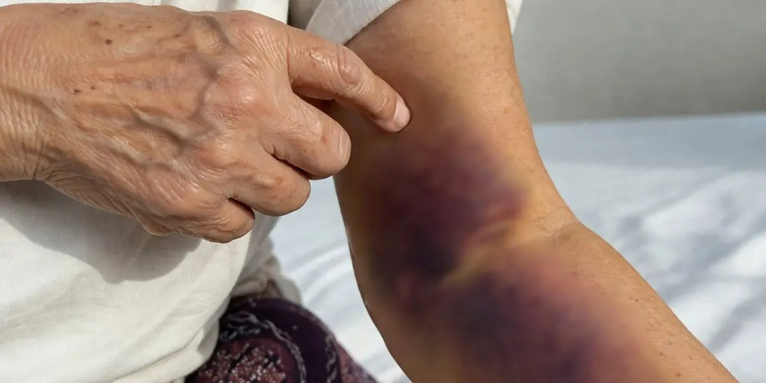 Инъекциядан кейін ақтаулық әйелдің қолы істемей қалған