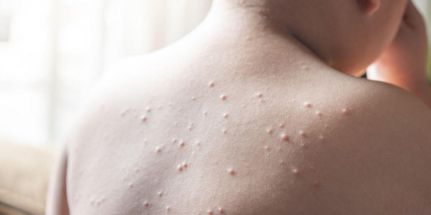 В Казахстане снизилась заболеваемость корью